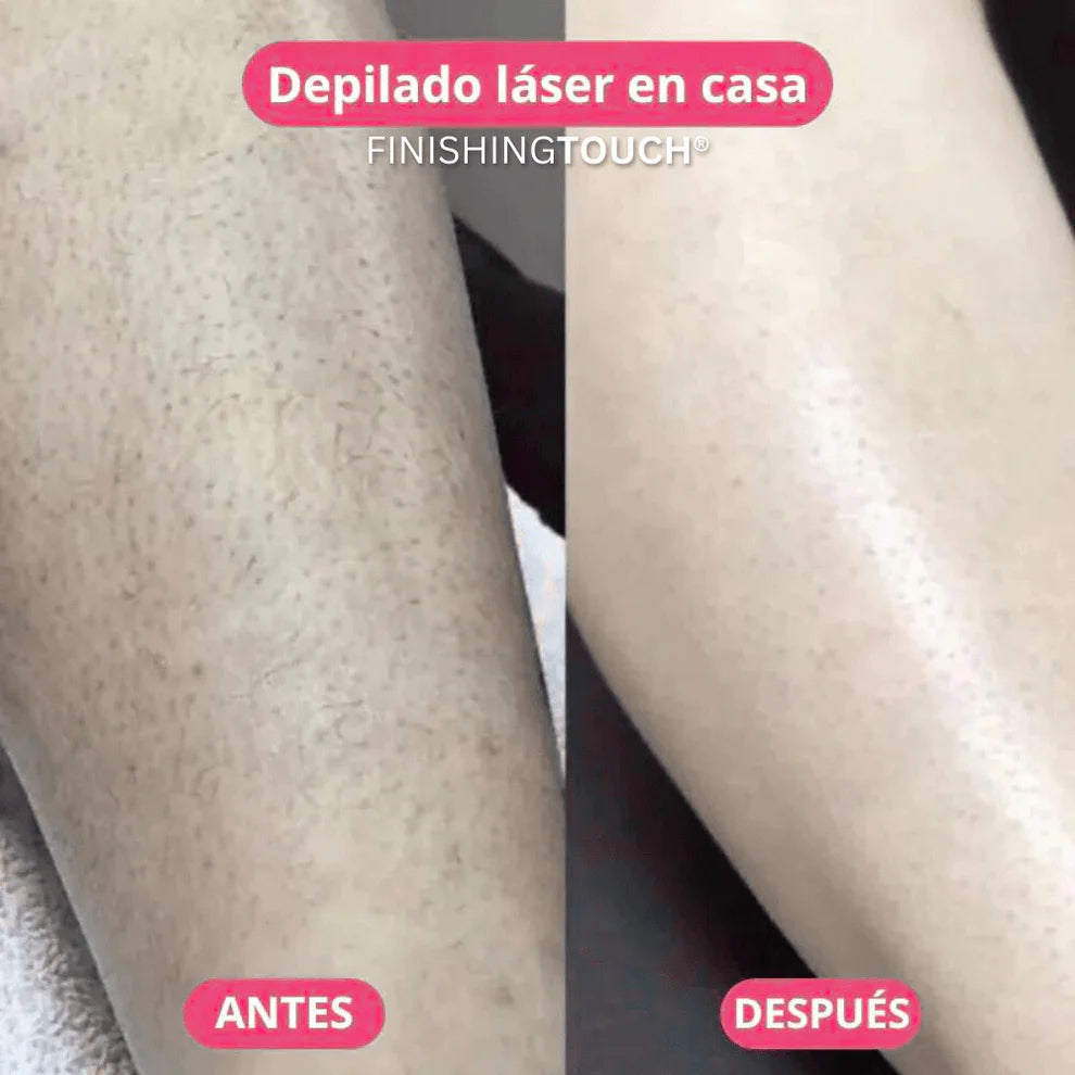 Velora™ | Depiladora Láser Corporal